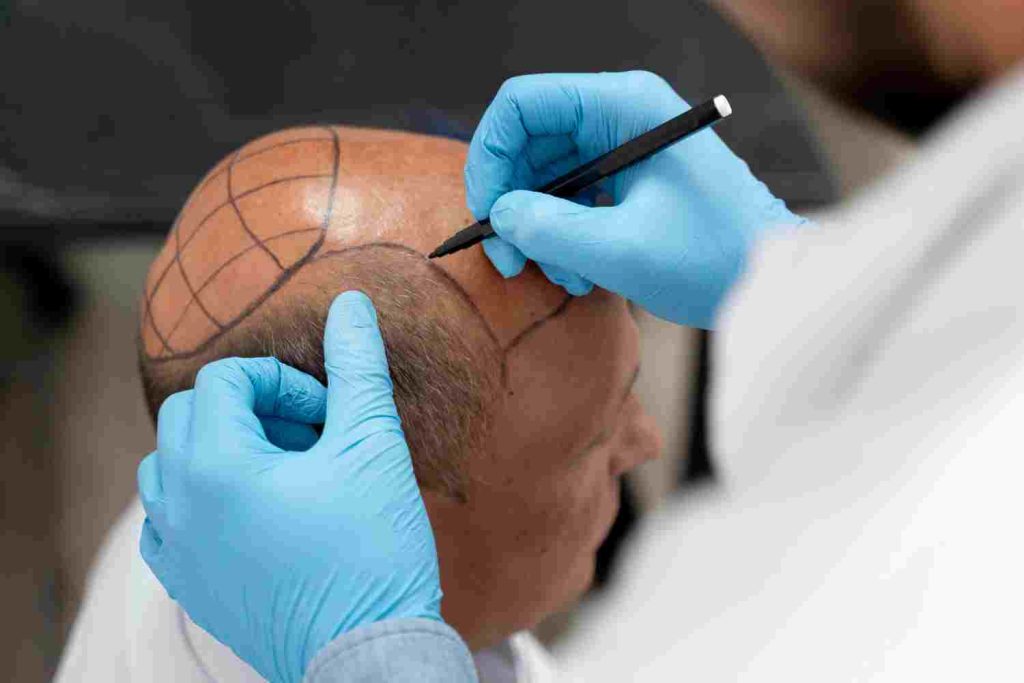 âge greffe de cheveux